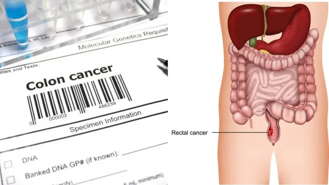 US Rectal Cancer Crisis, Deaths Rising Among Millennials, Doctors Sound Alarm