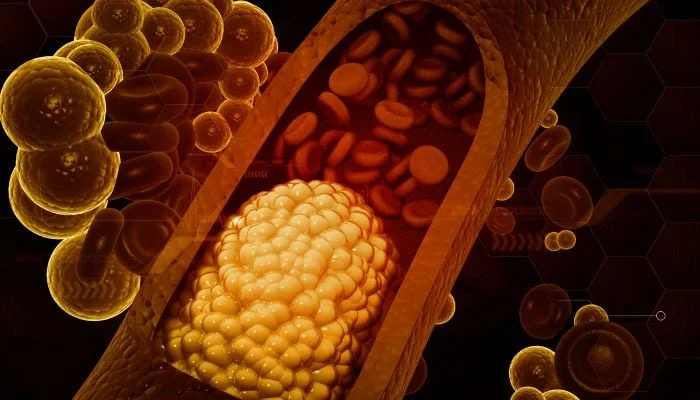 Cholesterol myths debunked: Cardiologists push back as misinformation spreads online